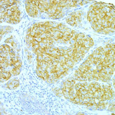 Areas containing RAB27A molecules (brown staining) within a section of a melanoma.